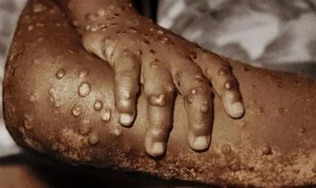 39 cases of Mpox recorded in Nigeria– NCDC