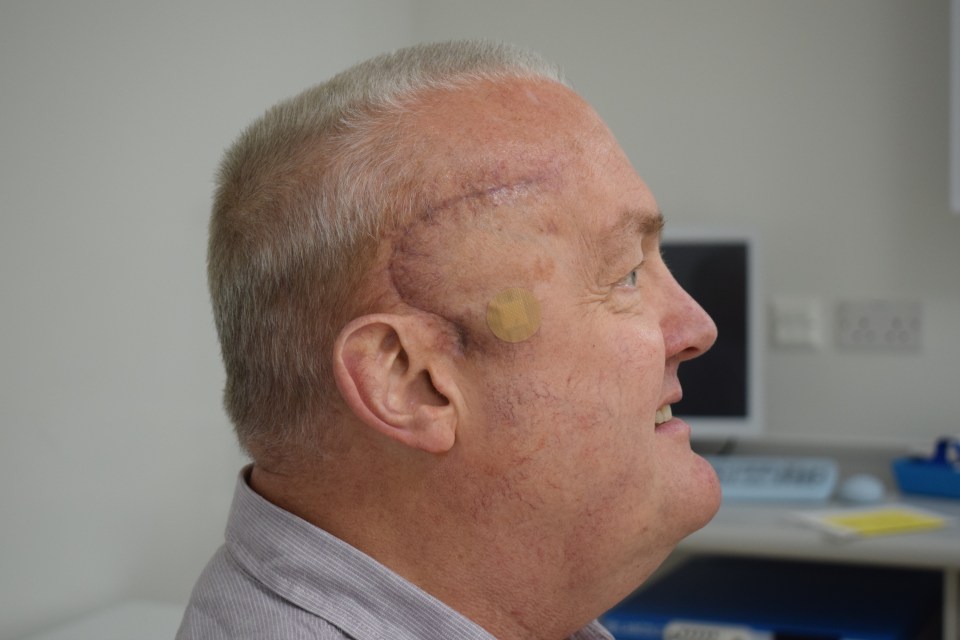 Paul’s scar from brain tumour surgery