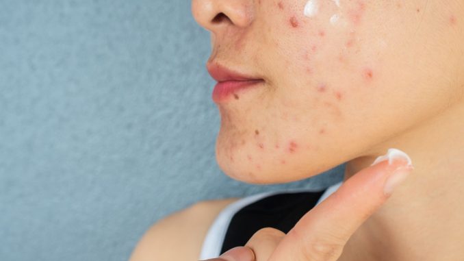 Acne Products May Release Benzene Even at Room Temperature, Study Shows