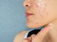 Acne Products May Release Benzene Even at Room Temperature, Study Shows