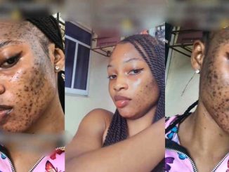 Lady develop facial rash after using skincare product heavily promoted on TikTok (WATCH)