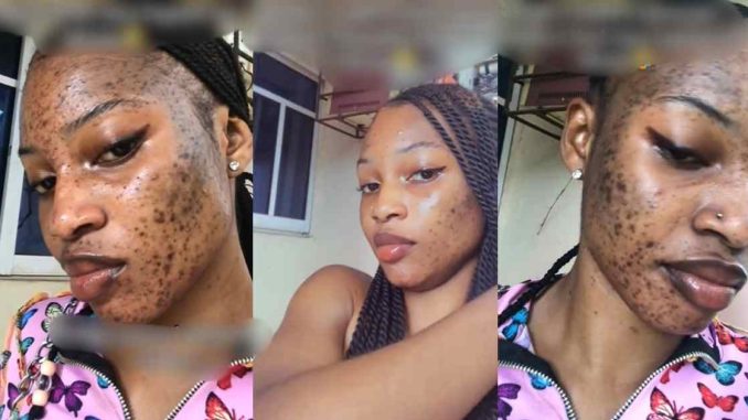 Lady develop facial rash after using skincare product heavily promoted on TikTok (WATCH)