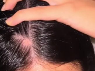 I’m only 23 but had a huge bald spot on my head - a homemade oil made my locks grow back thick and healthy