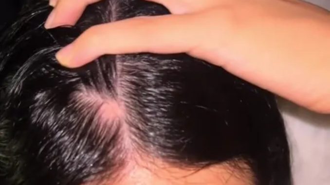 I’m only 23 but had a huge bald spot on my head - a homemade oil made my locks grow back thick and healthy