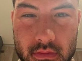 Love Island winner Liam Reardon shares shocking pictures of swollen face after food poisoning nightmare