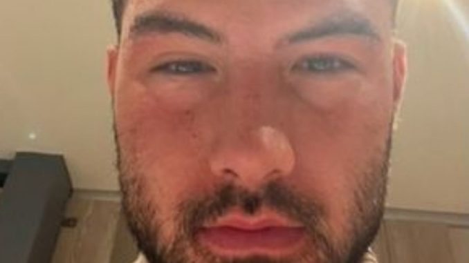 Love Island winner Liam Reardon shares shocking pictures of swollen face after food poisoning nightmare