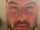 Love Island winner Liam Reardon shares shocking pictures of swollen face after food poisoning nightmare