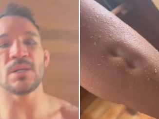 UFC star Michael Chandler shows off gruesome swelling on his legs with bizarre indents that don't disappear