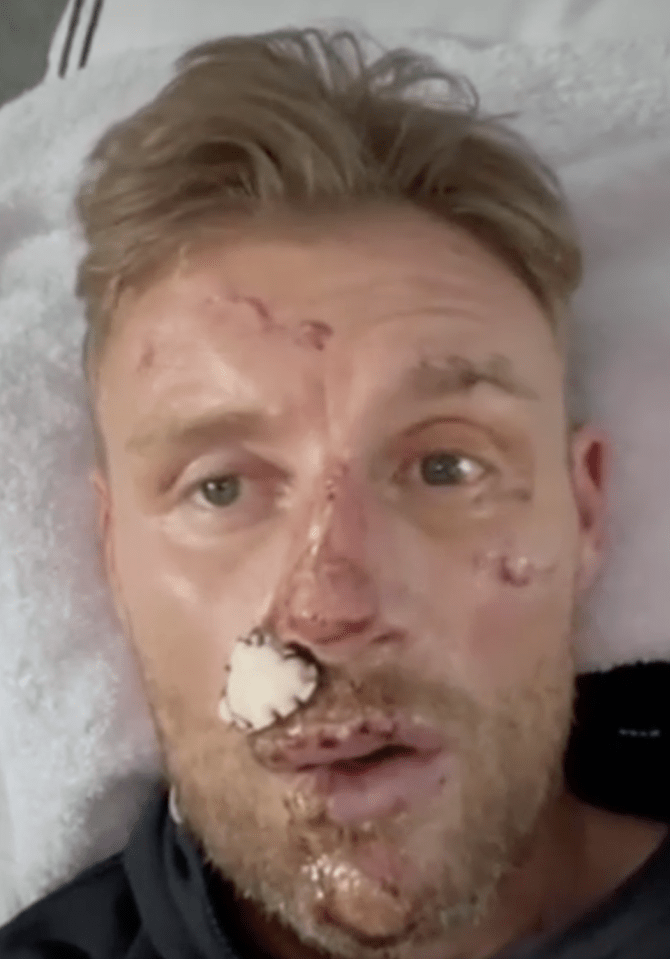 The England Ashes star was left permanently scarred and needed several surgeries