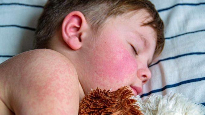 Global Measles Cases Jumped 20%. Here's How That Could Affect You