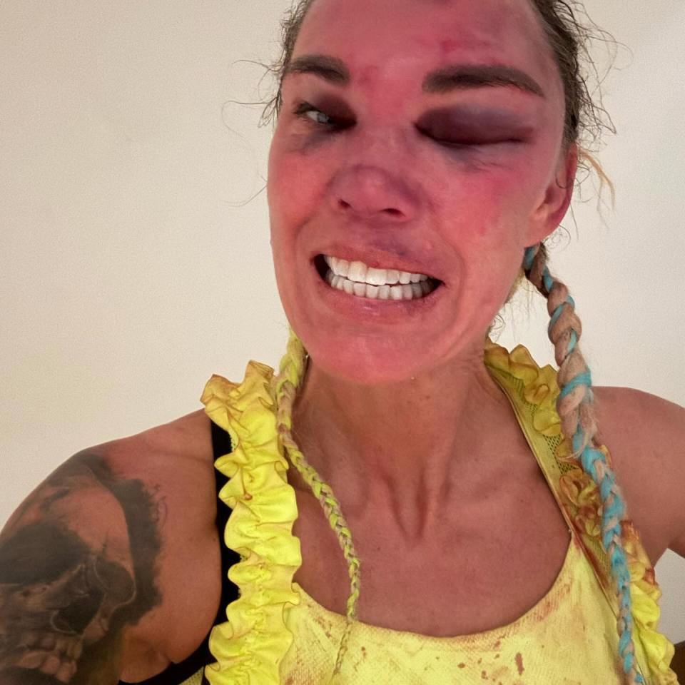 The Swedish slugger suffered horrific swelling around both of her eyes