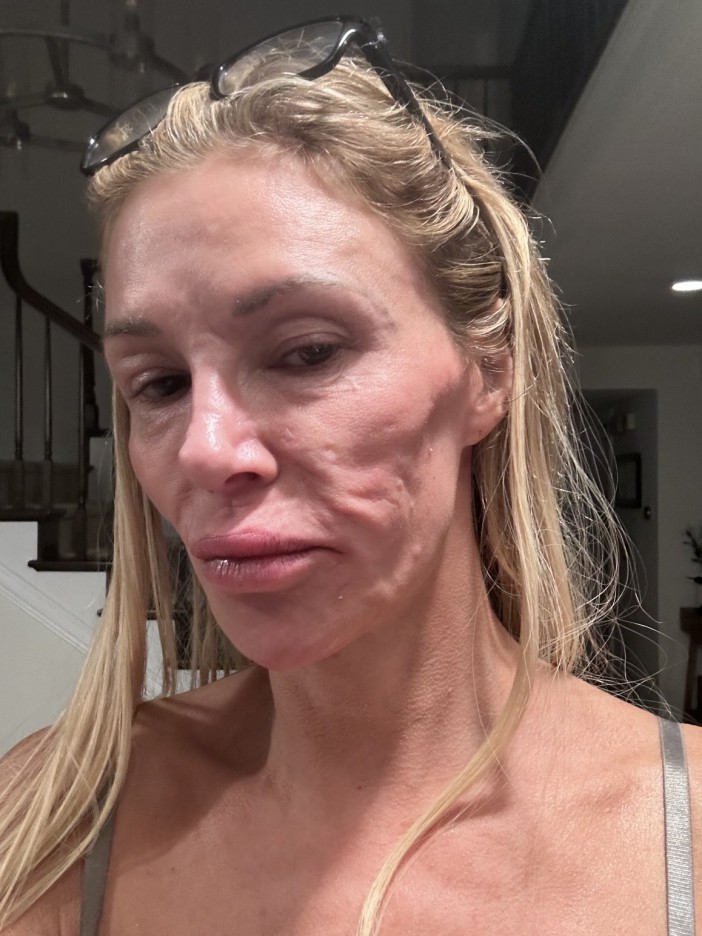 The reality star looks unrecongizable as she battles stress-induced angioedema